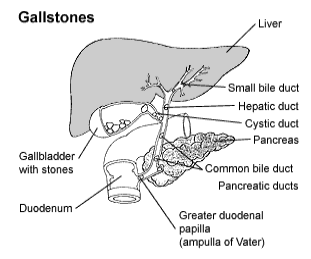 Cholesterol+gallstones+in+stool