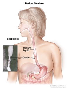 Barium swallow; shows barium liquid flowing through the esophagus and into the stomach.
