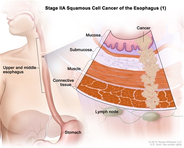 Stage IIA squamous cell cancer of the esophagus (1); drawing shows the esophagus and stomach. An inset shows the layers of the esophagus wall with cancer in the mucosa, submucosa, muscle, and connective tissue layers. Also shown are lymph nodes.