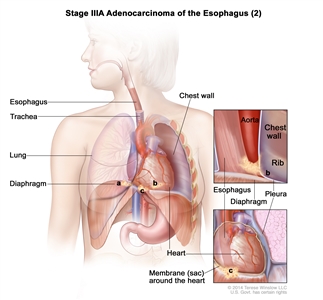 Stage IIIA adenocarcinoma of the esophagus (2); drawing shows the esophagus, trachea, and lung. The top inset shows cancer that has spread from the esophagus into the diaphragm and pleura; the aorta, chest wall, and rib are also shown. The bottom inset shows cancer that has spread from the esophagus into the membrane (sac) around the heart.