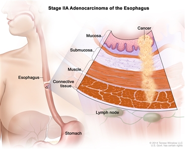 Stage IIA adenocarcinoma of the esophagus; drawing shows the esophagus and stomach. An inset shows cancer in the mucosa, submucosa, and muscle layers of the esophagus wall. Also shown is the connective tissue layer of the esophagus wall and lymph nodes.