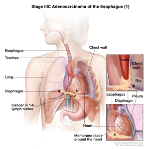 Stage IIIC adenocarcinoma of the esophagus (1); drawing shows the esophagus, trachea, and lung. The top inset shows cancer that has spread from the esophagus into the diaphragm and pleura; the aorta, chest wall, and rib are also shown. The bottom inset shows cancer that has spread from the esophagus into the membrane (sac) around the heart. Also shown is cancer in lymph nodes near the esophagus.