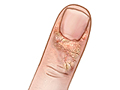 Picture of a periungual wart
