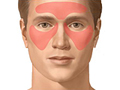 Picture of sinus headache: areas of pain