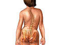 Picture of scoliosis