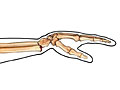 Wrist fracture (distal radius fracture)