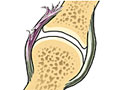 Moderate sprain of ulnar collateral ligament of the thumb