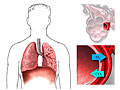 Picture of gas exchange in the lungs