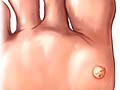 Picture of plantar warts