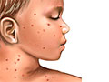 Picture of chickenpox rash