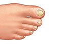 Picture of fungal nail infection