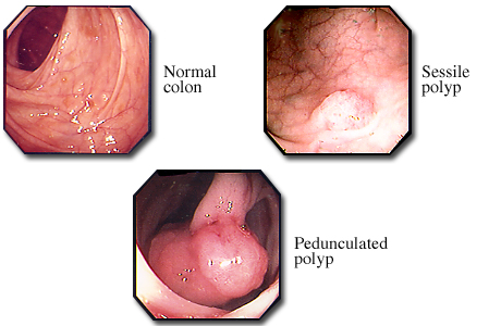 Normal colon and colon polyps