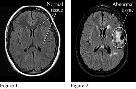 Images of normal brain tissue and abnormal brain tissue that causes seizures