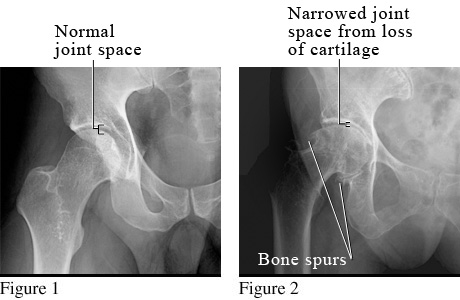 X-ray of osteoarthritis of the hip