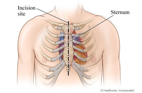 Location of incision in chest 