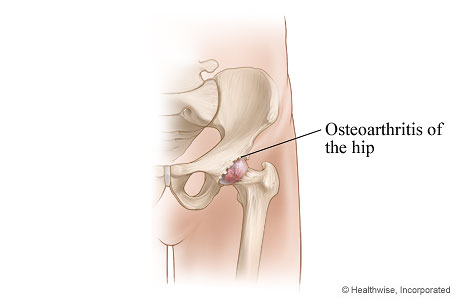 Osteoarthritis of the hip