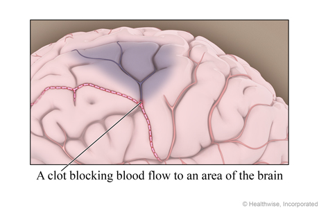 An ischemic stroke