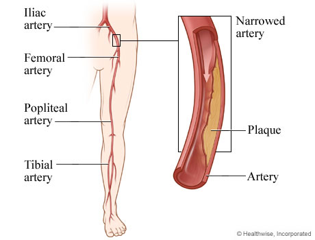 Picture of peripheral arterial disease of the legs