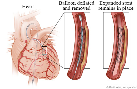 Deflated balloon leaving an expanded stent in place 