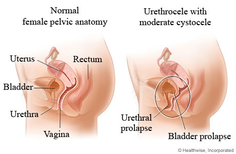 Urethrocele