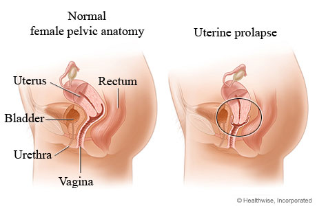 Uterine prolapse