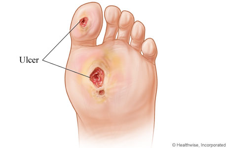 Diabetic foot ulcers