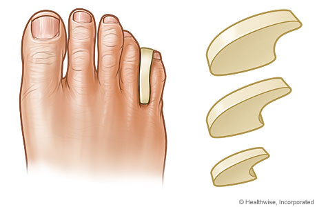 Different sizes of toe separators and one inserted between two toes