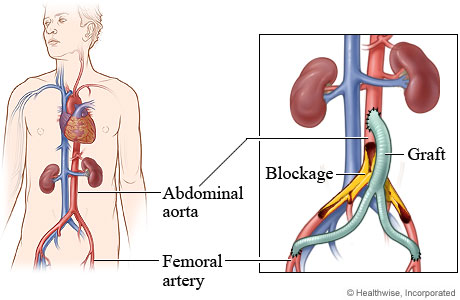 Abdominal and femoral arteries with detail  of a blockage and a graft