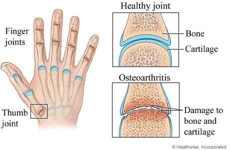 Osteoarthritis of the hand