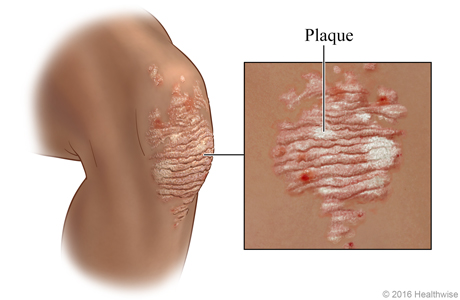 Psoriasis plaque on a knee