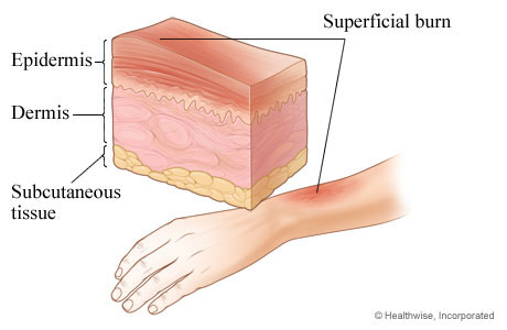 First-degree burn: superficial burn