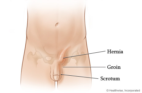 Inguinal hernia