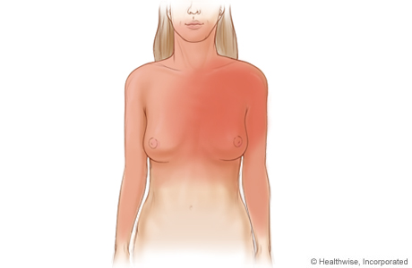 Picture of common areas where angina symptoms can be felt