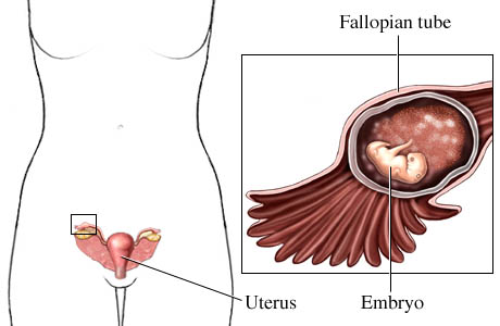 Ectopic pregnancy