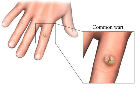 Common wart