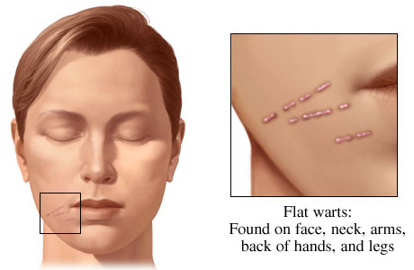 Flat warts