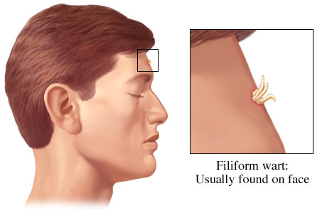 Filiform wart