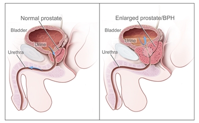 Two-panel drawing shows normal male reproductive and urinary anatomy and benign prostatic hyperplasia (BPH). Panel on the left shows the normal prostate and flow of urine from the bladder through the urethra. Panel on the right shows an enlarged prostate pressing on the bladder and urethra, blocking the flow of urine.