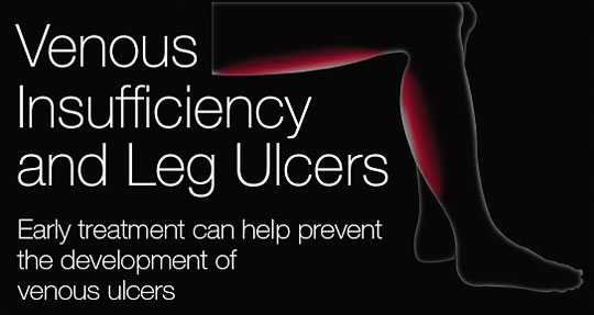 Venous Insufficiency and Leg Ulcers Early treatment can help prevent the development of venous ulcers