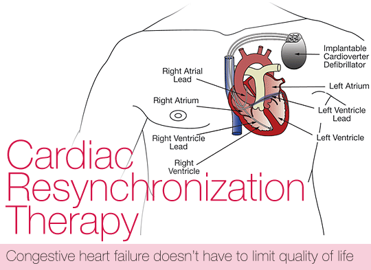 Cardiac Resynchronization Therapy title
